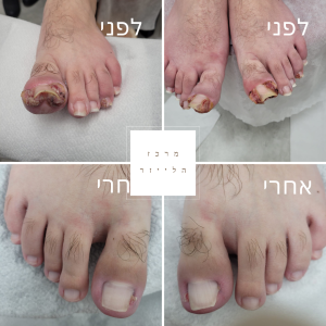 תמונות של ציפורן חודרנית לפני ואחרי