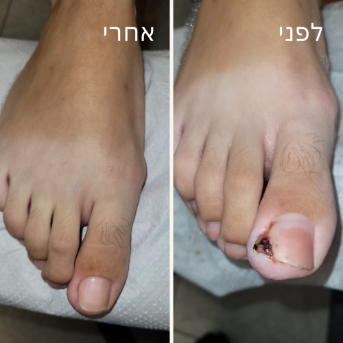 תמונה של ציפורן חודרנית לפני ואחרי