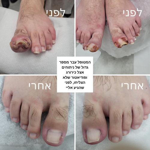 תמונות של ציפורן חודרנית לפני ואחרי